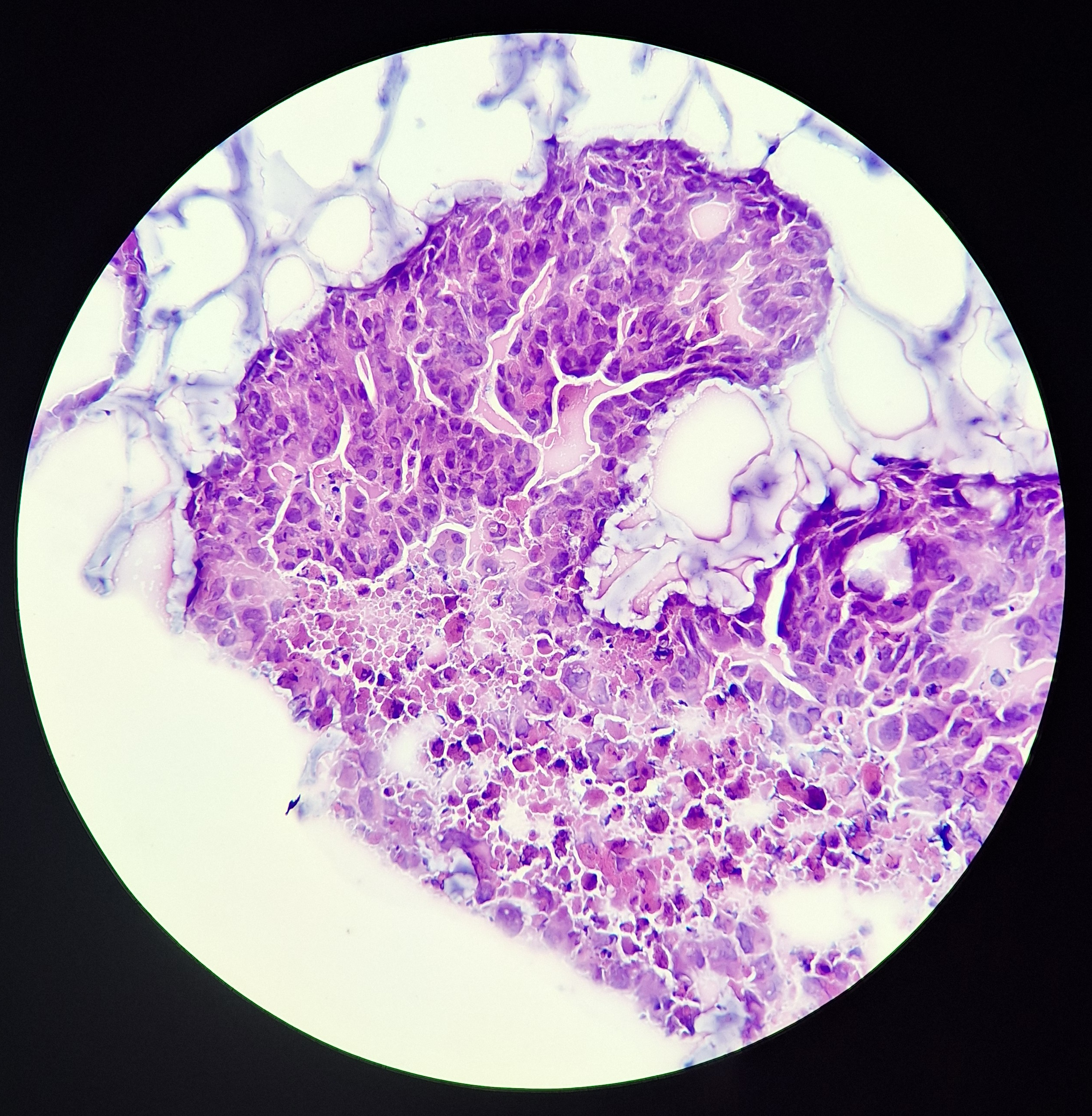 PDAC organoids SO1 from Systems Oncology