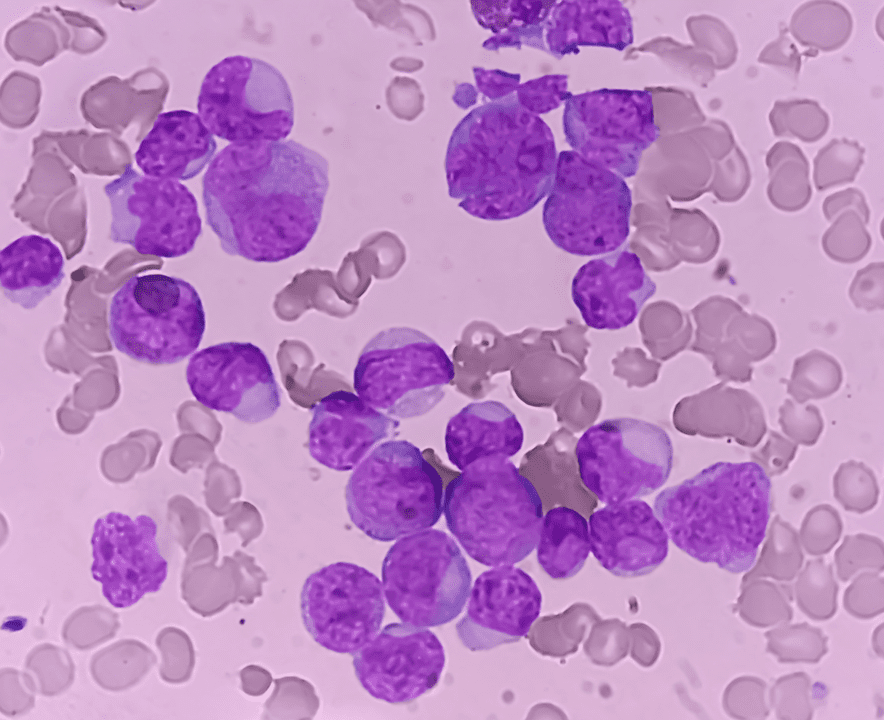Image of AML blast cells