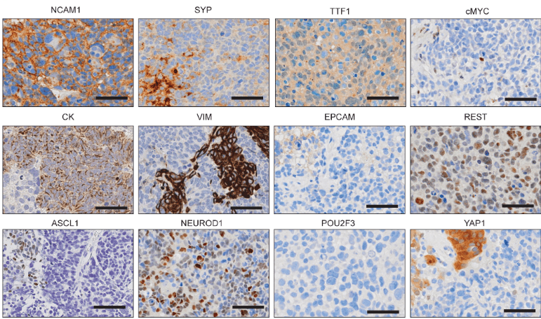 CDX21 donor patient representative IHC images