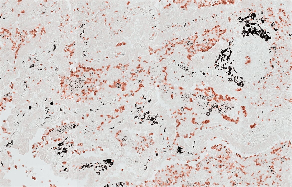 Translational Lung Cancer Biology