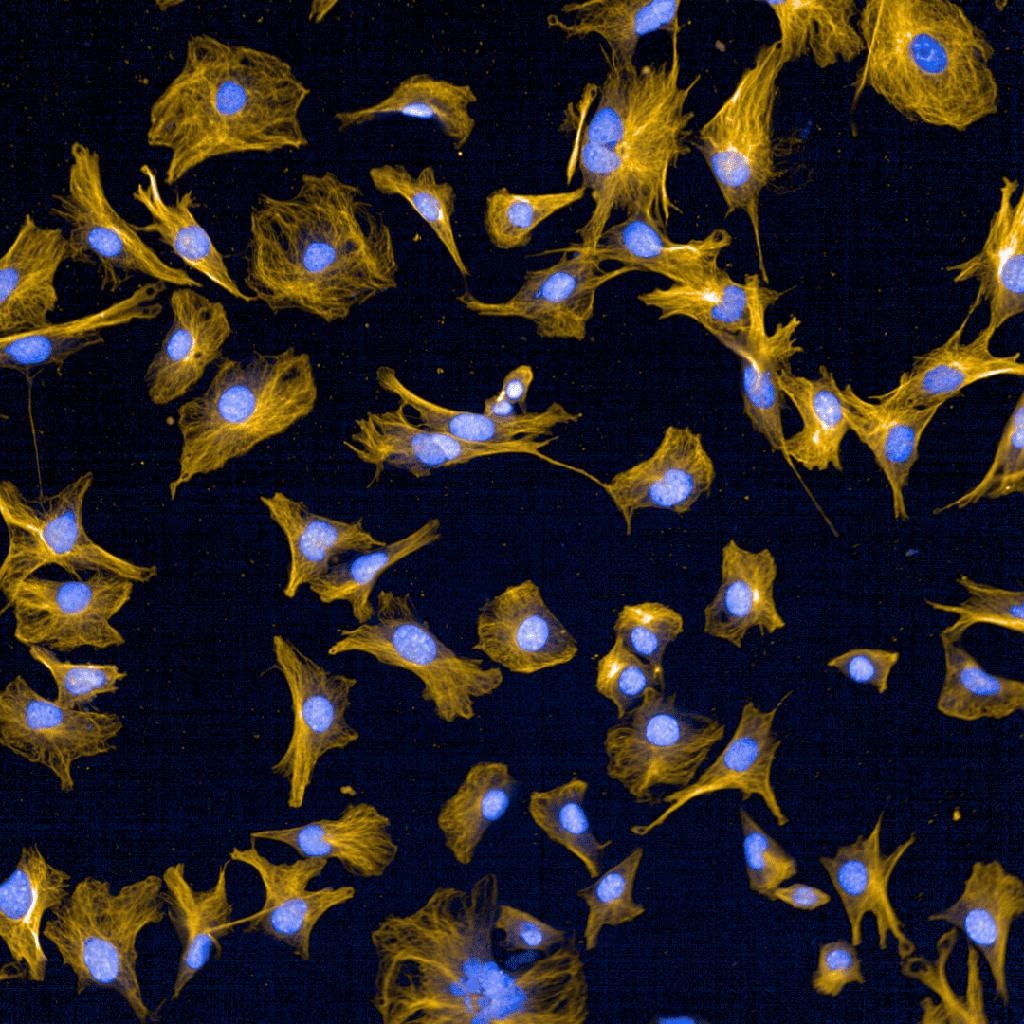 Image of cells in pancreatic cancer