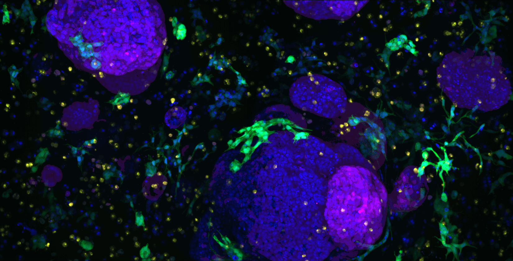 Pancreatic cancer organoids co-cultured with fibroblasts