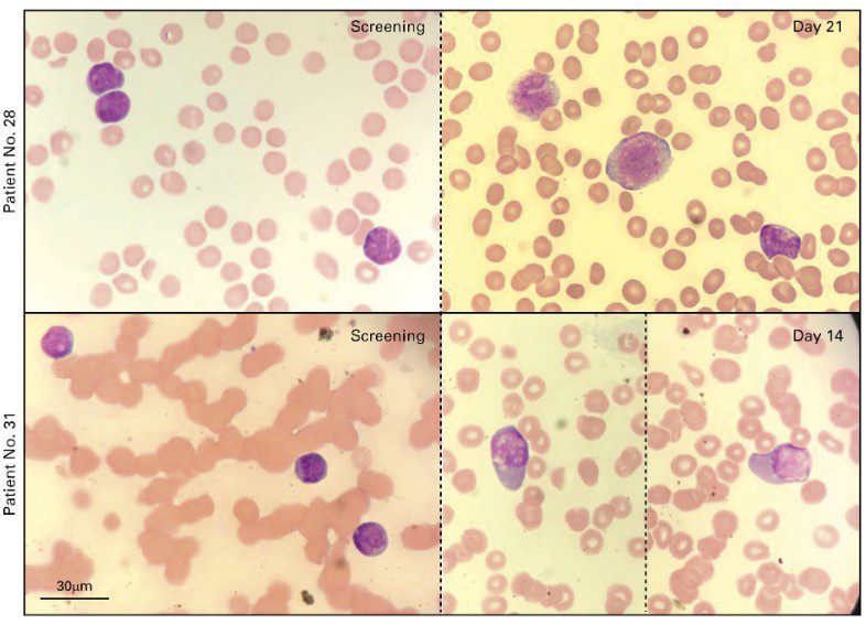 Morphologic response to treatment with iadademstat. (A) Representative images of blood smears showing morphologic differentiation from patient 28 (top) at screening (left) and cycle 1(C1), day 21 (D21) (right) and patient 31 (bottom) at screening (left) and C1D14 (right; two images from the same slide and patient are shown, separated by a dotted line).