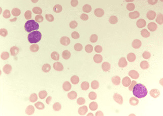 Leukemia Biology cells image