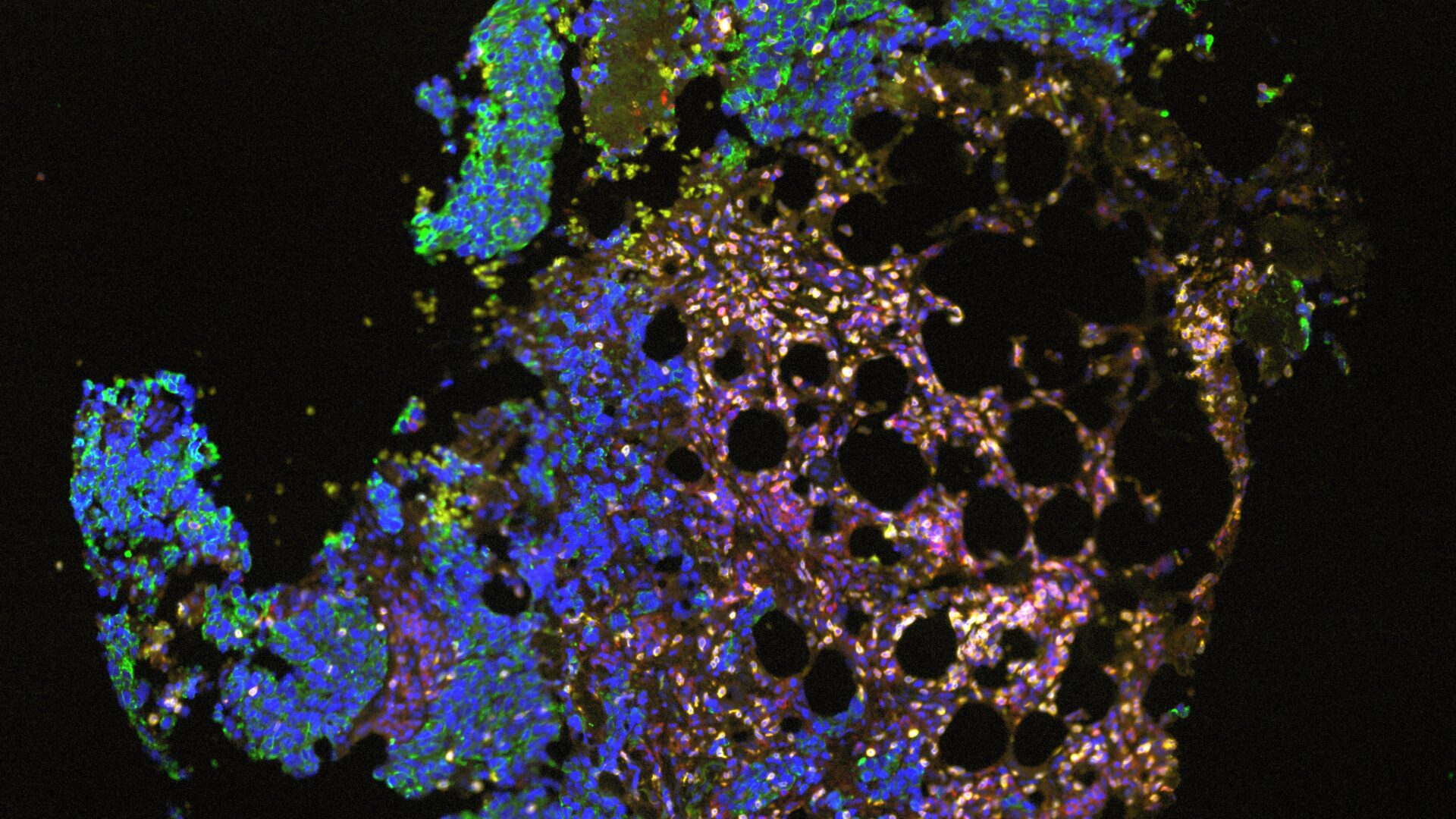 A histological image of a cancer sample stained in blue, orange, green and showing the structure of the tissue sample