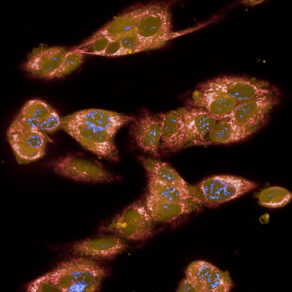 Image of skin cancer in ageing humans